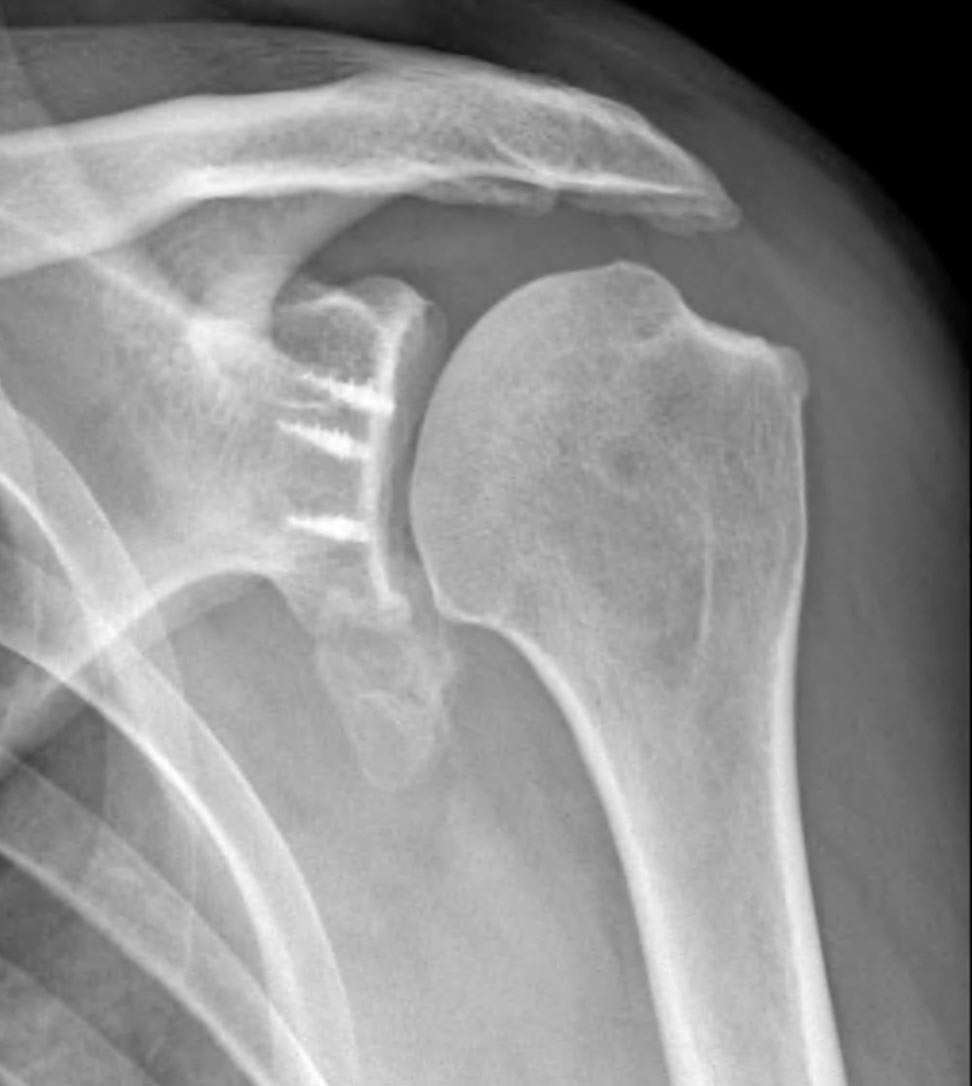 SA11 TSA Surgeon J SANCHEZ SOTELO Annecy Live Surgery June 8 9 5-stretches-for-a-frozen-shoulder-sword-health